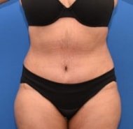 Tummy Tuck Westchester White Plains NYC, NY