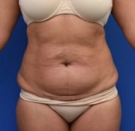 FUPA, FAT UPPER PELVIC AREA - New York Liposuction Center